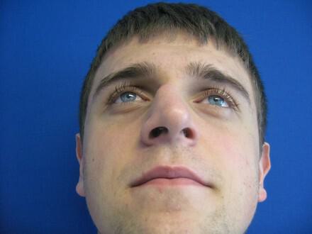 Male Rhinoplasty Before & After Image