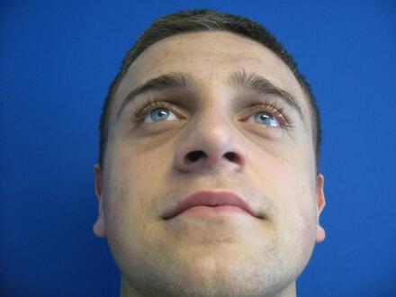 Male Rhinoplasty Before & After Image