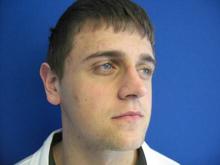 Male Rhinoplasty Before & After Image