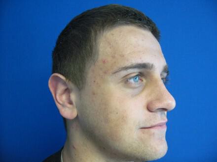 Male Rhinoplasty Before & After Image