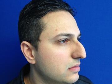 Male Rhinoplasty Before & After Image