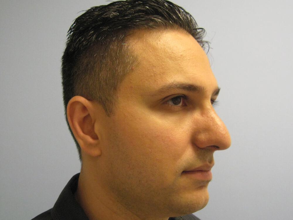 Male Rhinoplasty Before & After Image