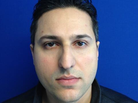 Male Rhinoplasty Before & After Image