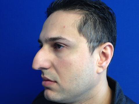 Male Rhinoplasty Before & After Image