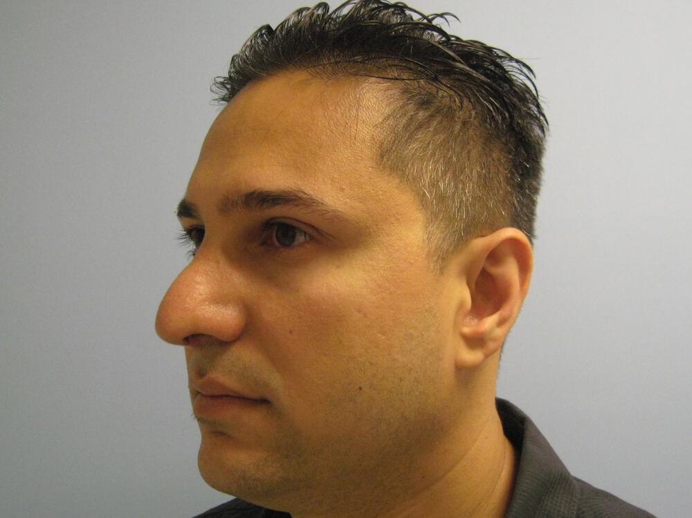 Male Rhinoplasty Before & After Image