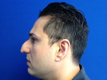 Male Rhinoplasty Before & After Image