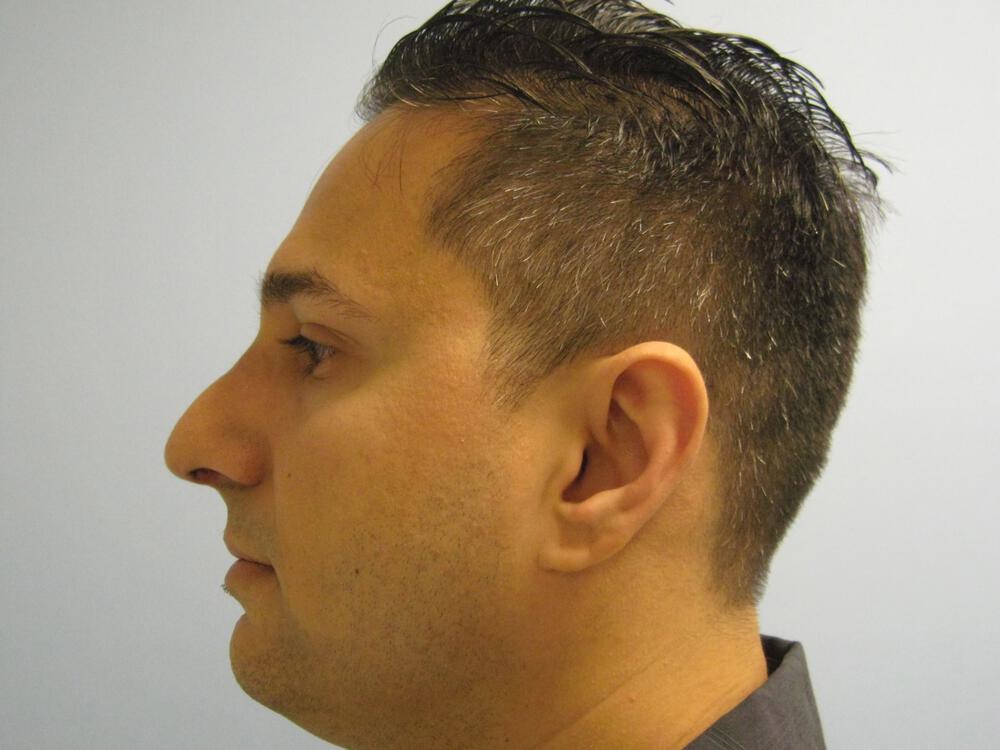 Male Rhinoplasty Before & After Image