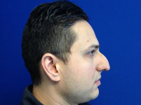 Male Rhinoplasty Before & After Image