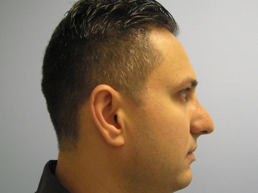 Male Rhinoplasty Before & After Image