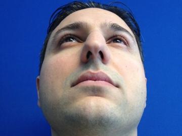 Male Rhinoplasty Before & After Image