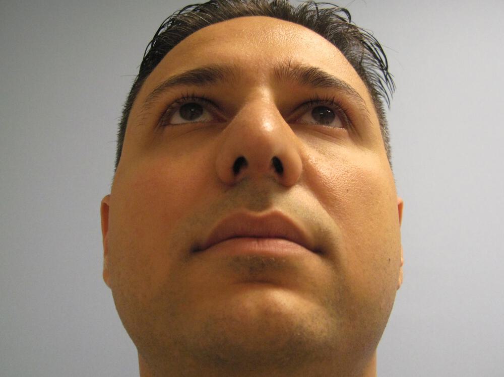 Male Rhinoplasty Before & After Image