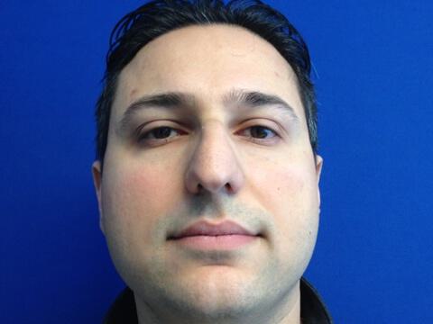 Male Rhinoplasty Before & After Image