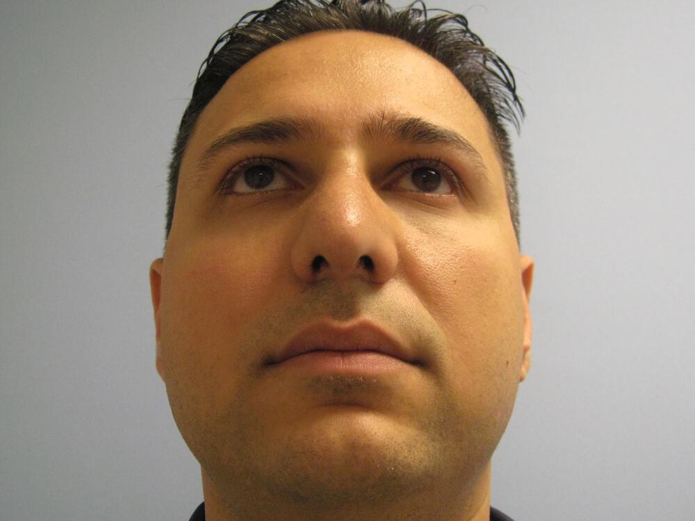 Male Rhinoplasty Before & After Image