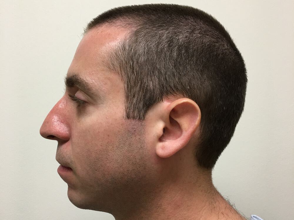 Male Rhinoplasty Before & After Image