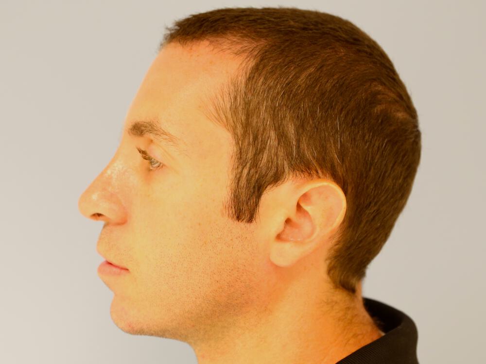 Male Rhinoplasty Before & After Image