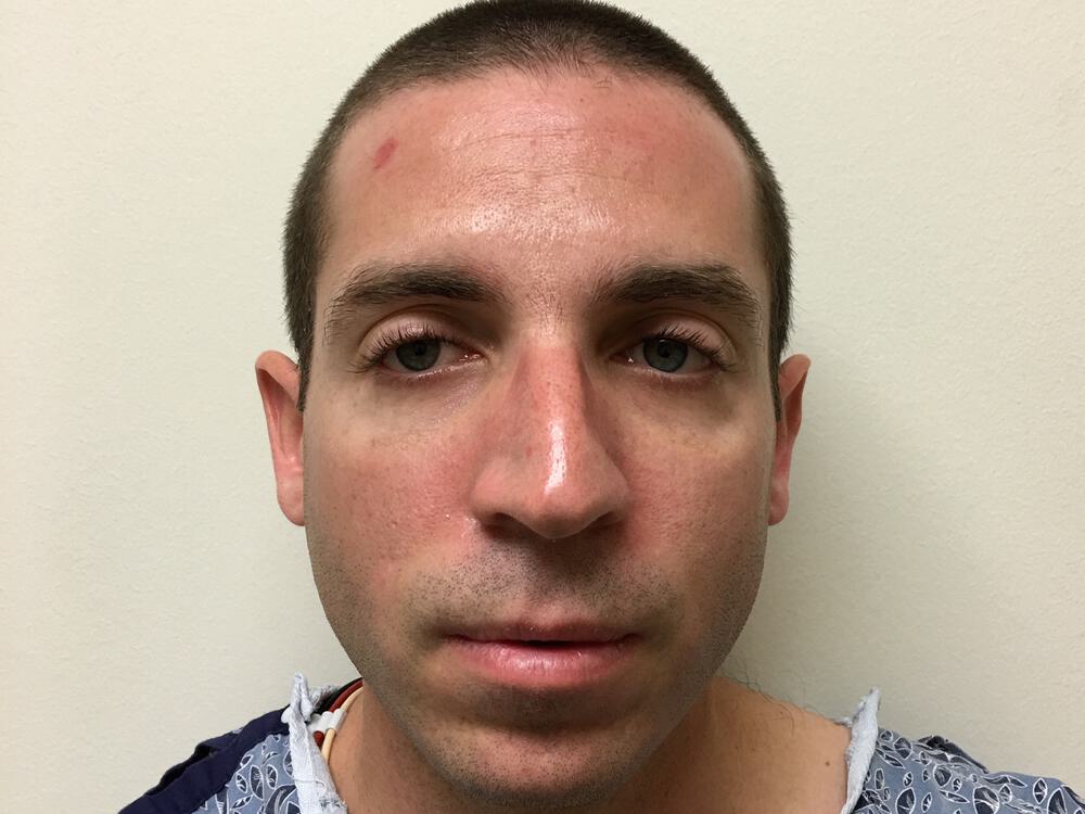 Male Rhinoplasty Before & After Image