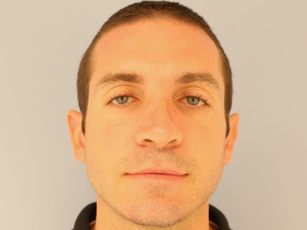 Male Rhinoplasty Before & After Image