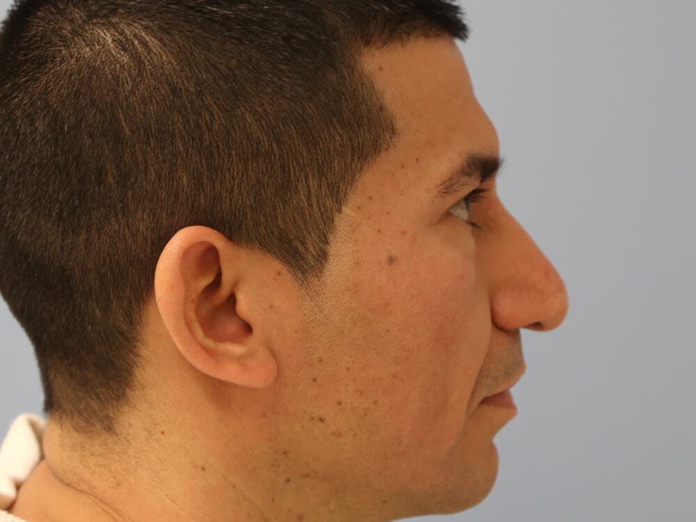 Male Rhinoplasty Before & After Image