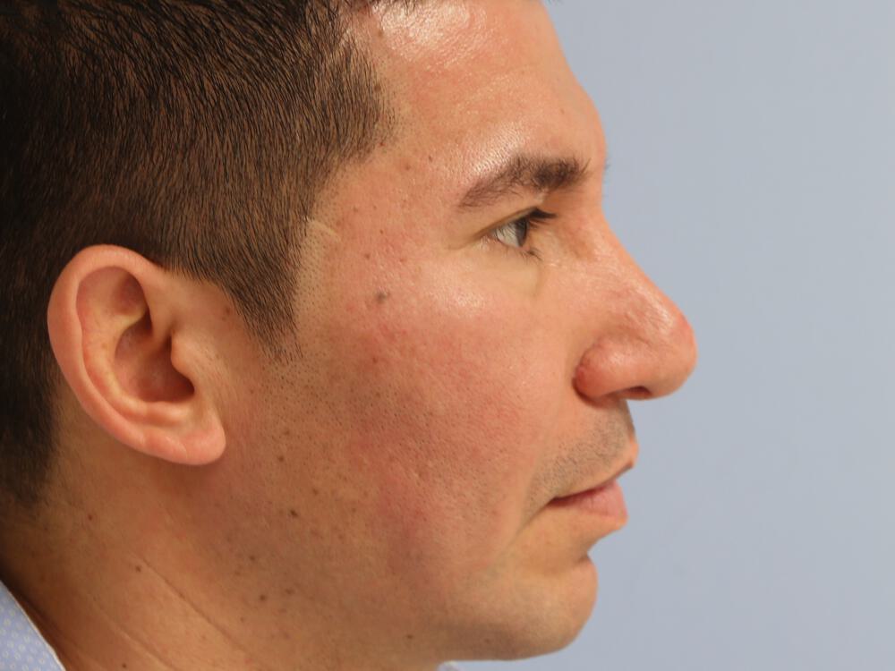 Male Rhinoplasty Before & After Image