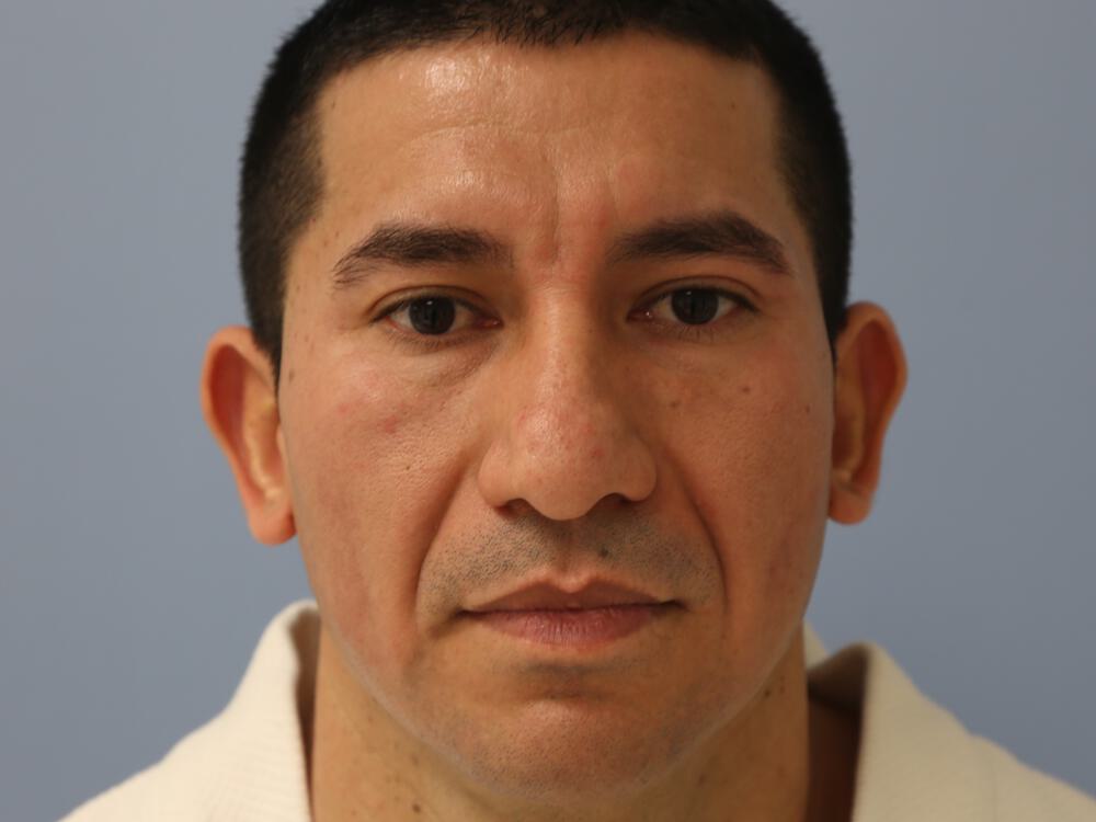 Male Rhinoplasty Before & After Image