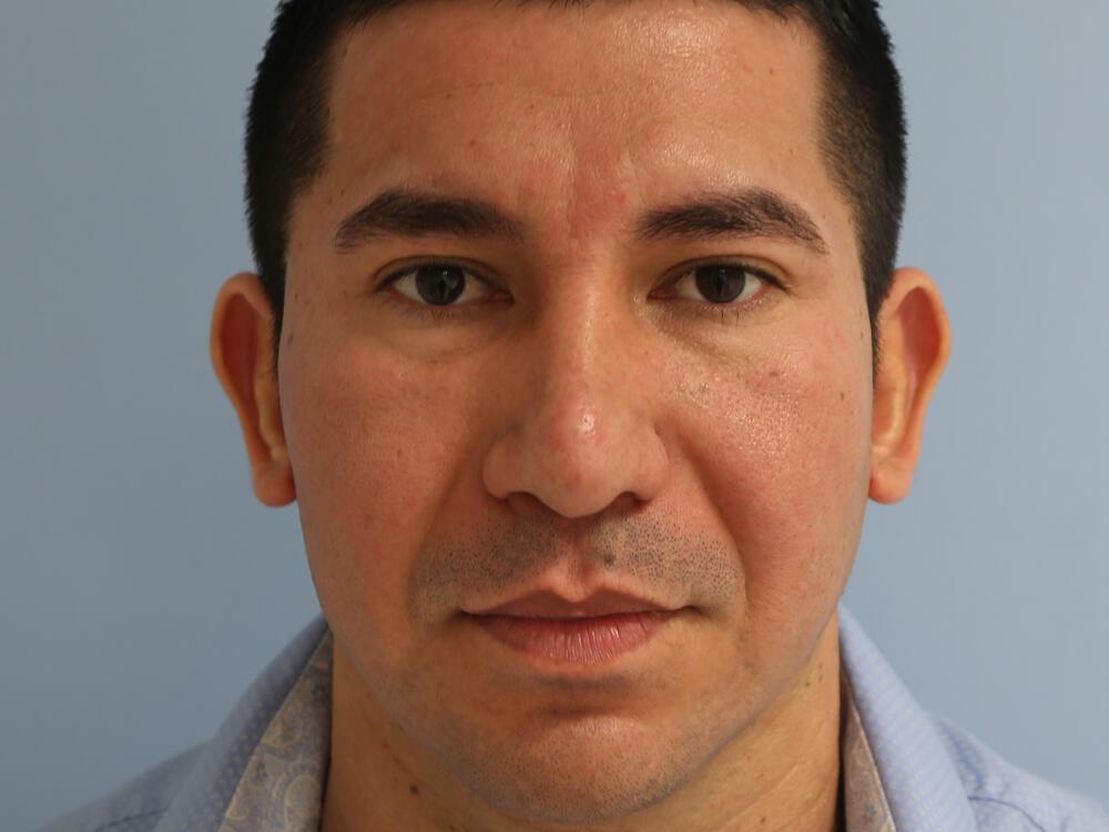 Male Rhinoplasty Before & After Image
