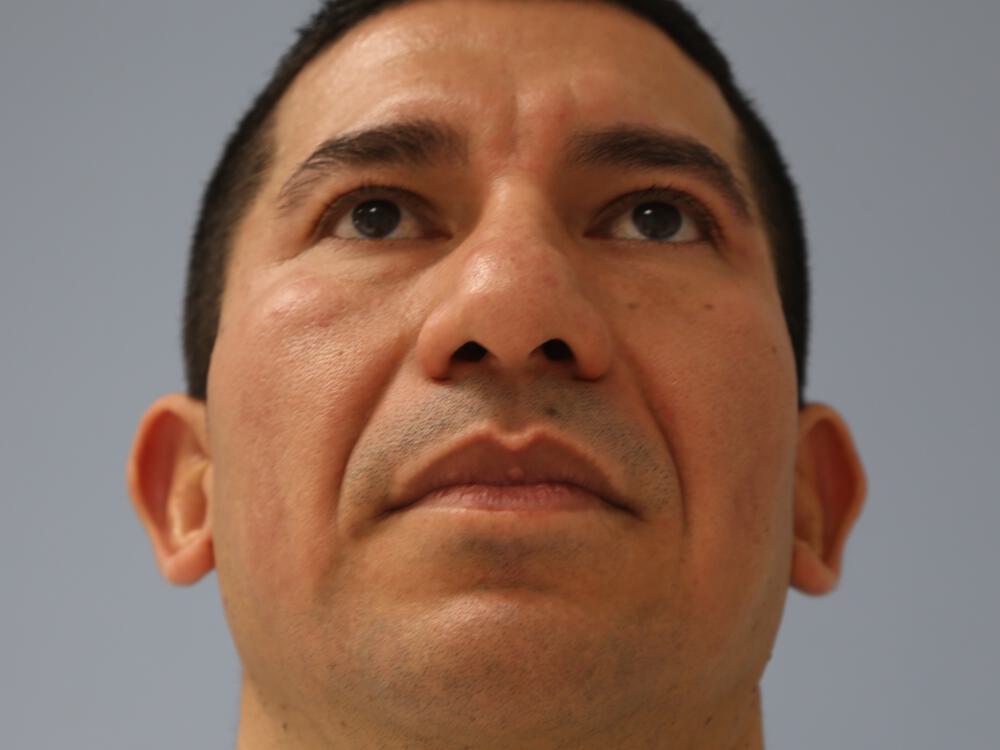 Male Rhinoplasty Before & After Image