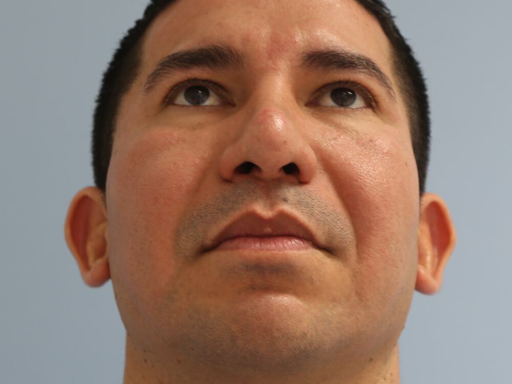 Male Rhinoplasty Before & After Image