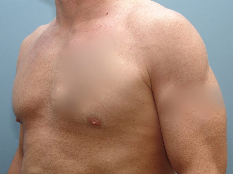 Pectoral Implants Before & After Image