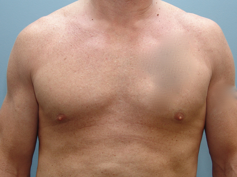 Pectoral Implants Before & After Image
