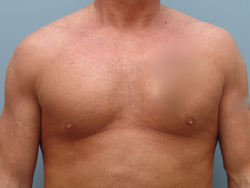 Pectoral Implants Before & After Image