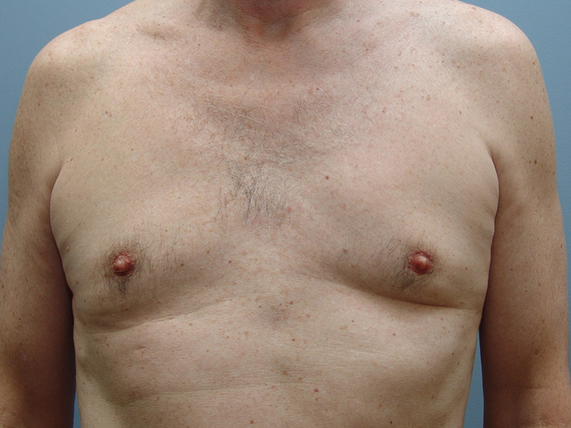 Pectoral Implants Before & After Image