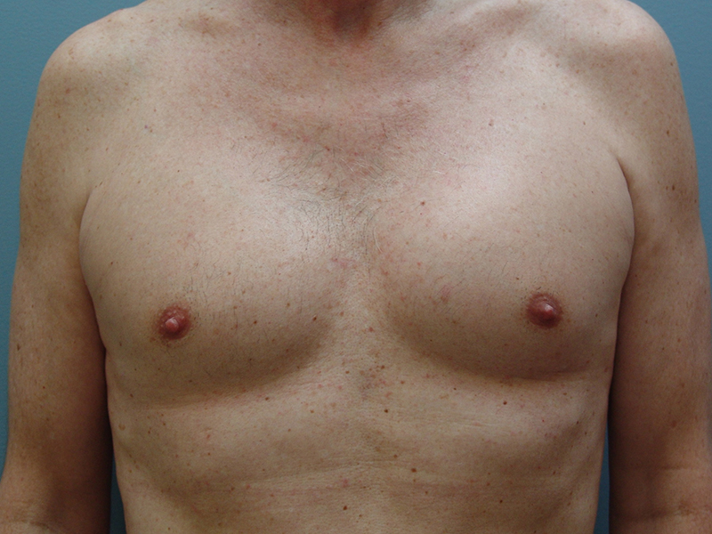 Pectoral Implants Before & After Image