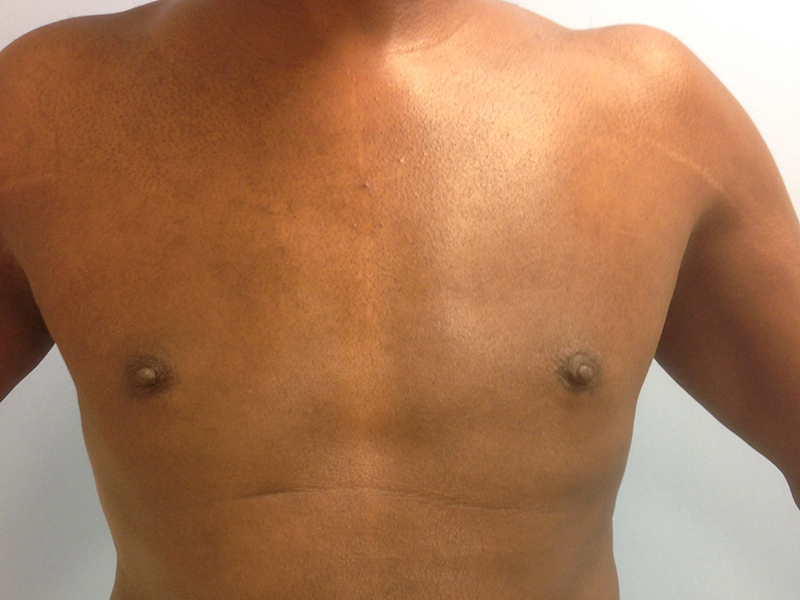Pectoral Implants Before & After Image