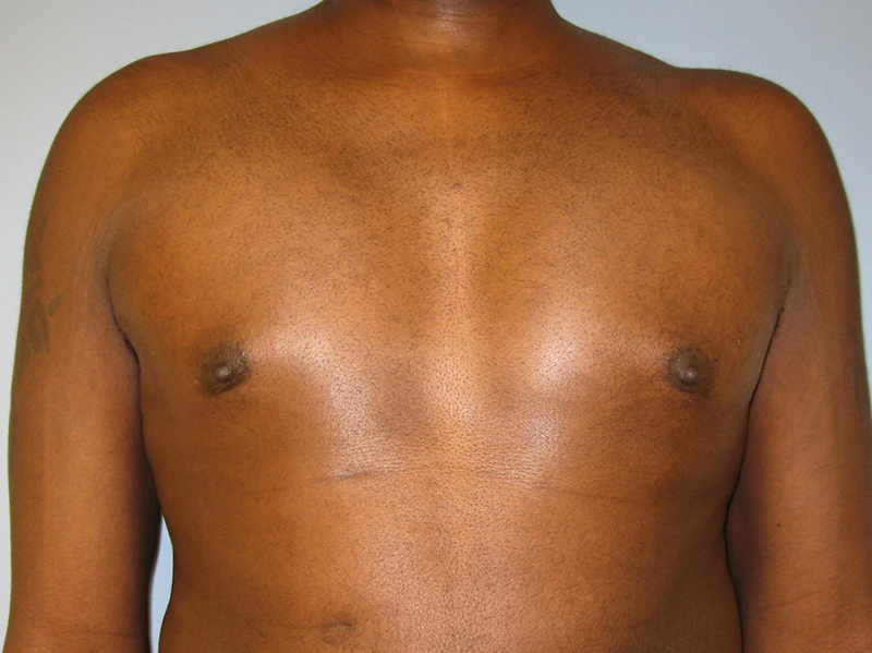 Pectoral Implants Before & After Image
