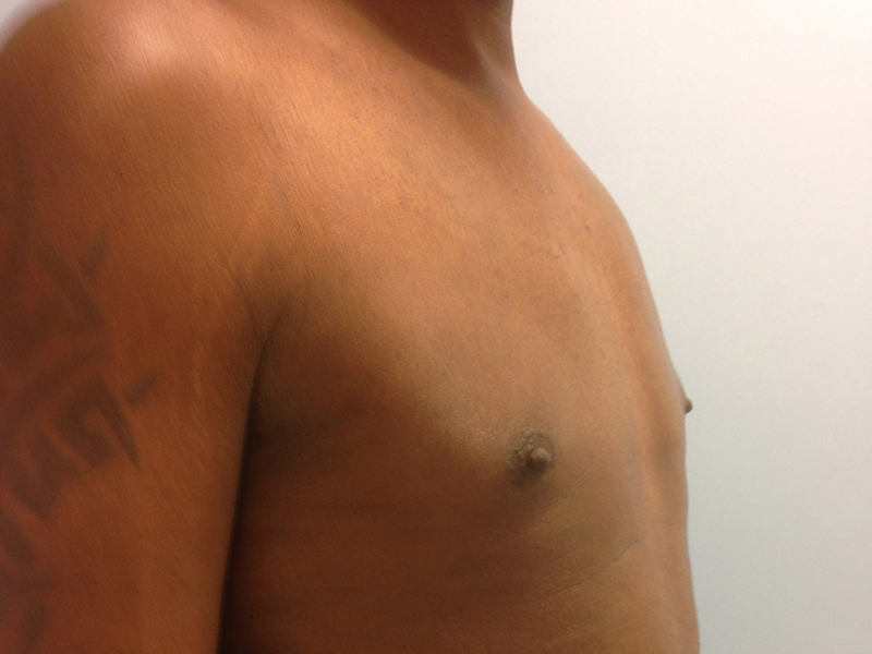 Pectoral implants Before & After Image