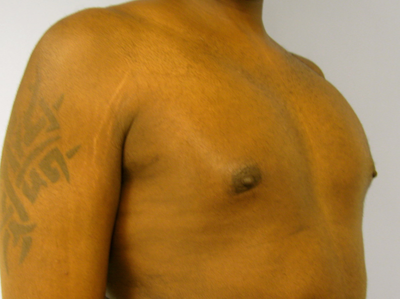 Pectoral implants Before & After Image