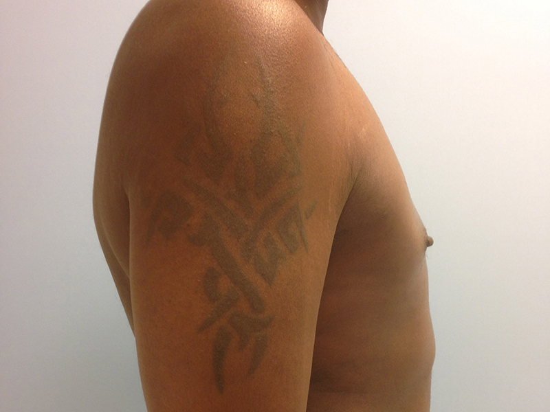 Pectoral Implants Before & After Image