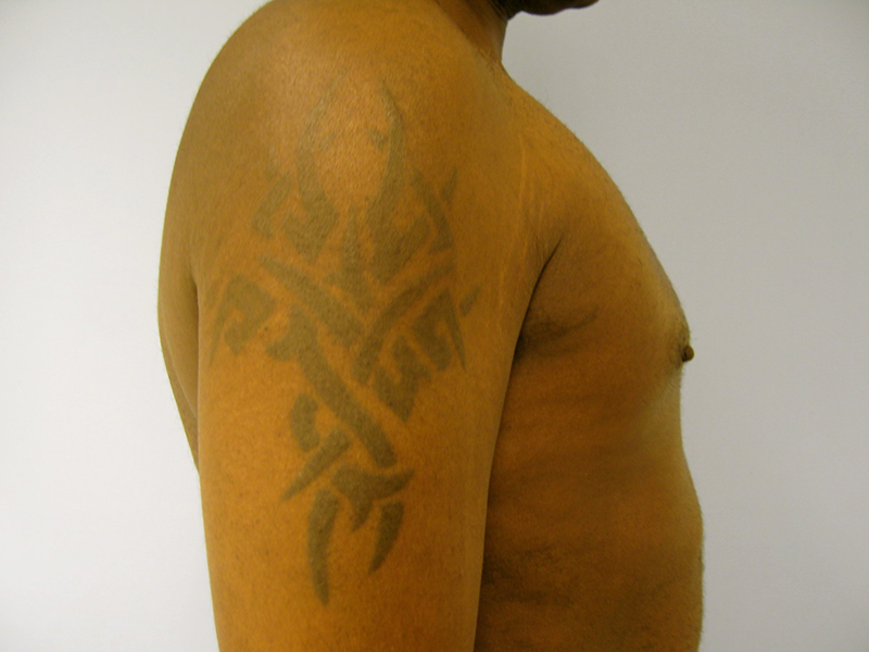 Pectoral Implants Before & After Image