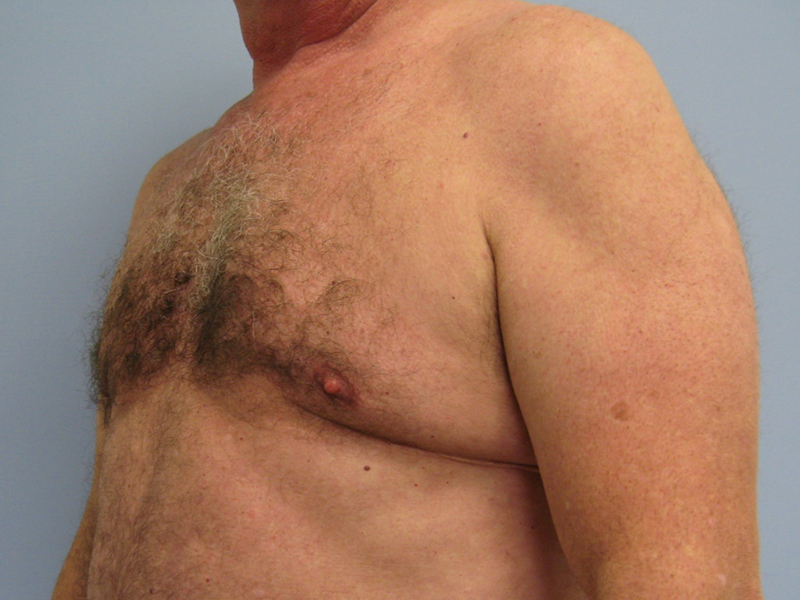 Pectoral implants Before & After Image