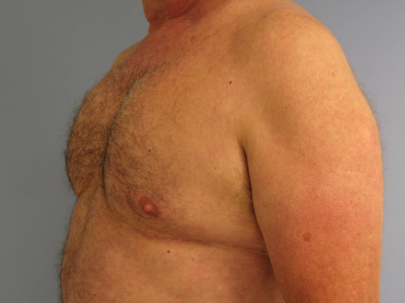 Pectoral implants Before & After Image