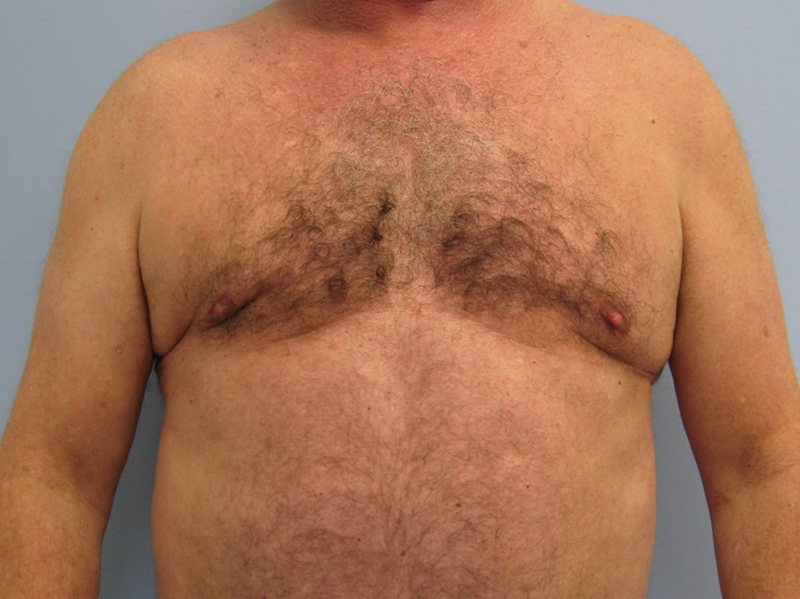 Pectoral implants Before & After Image