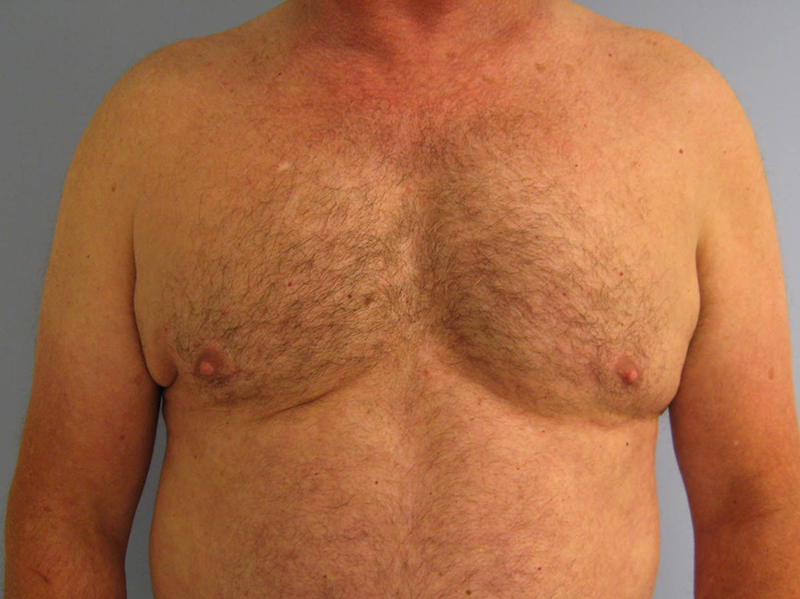 Pectoral implants Before & After Image
