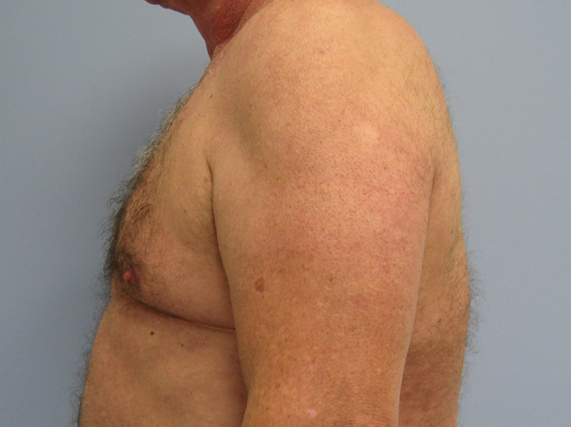 Pectoral Implants Before & After Image