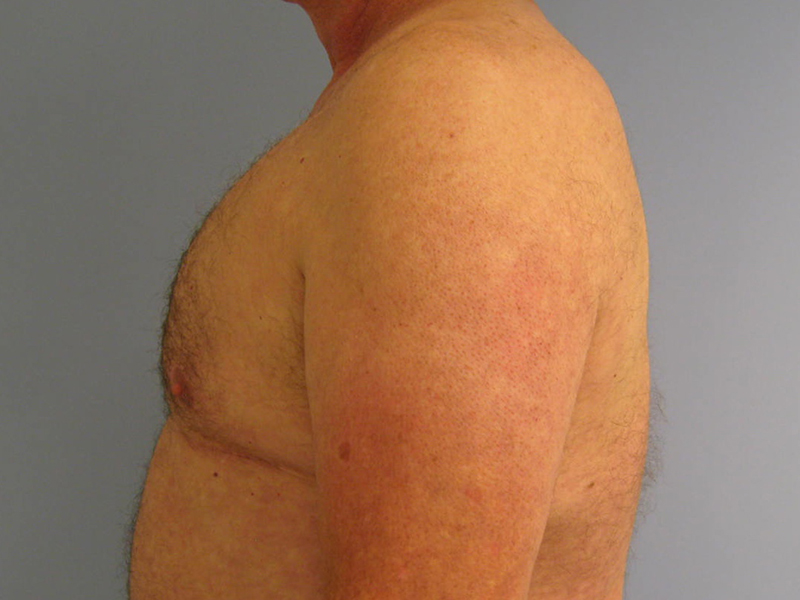 Pectoral Implants Before & After Image