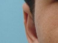 Male Prominent Ears Before & After Image