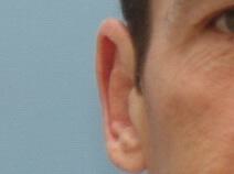 Male Prominent Ears Before & After Image