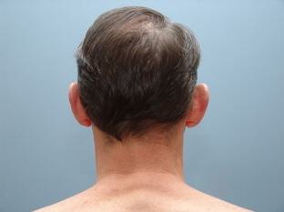 Male Prominent Ears Before & After Image