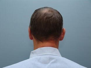 Male Prominent Ears Before & After Image