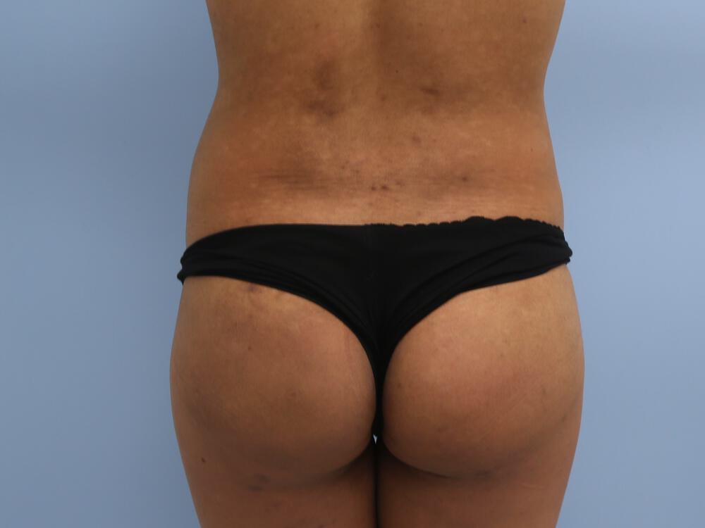 Butt Augmentation Before & After Image
