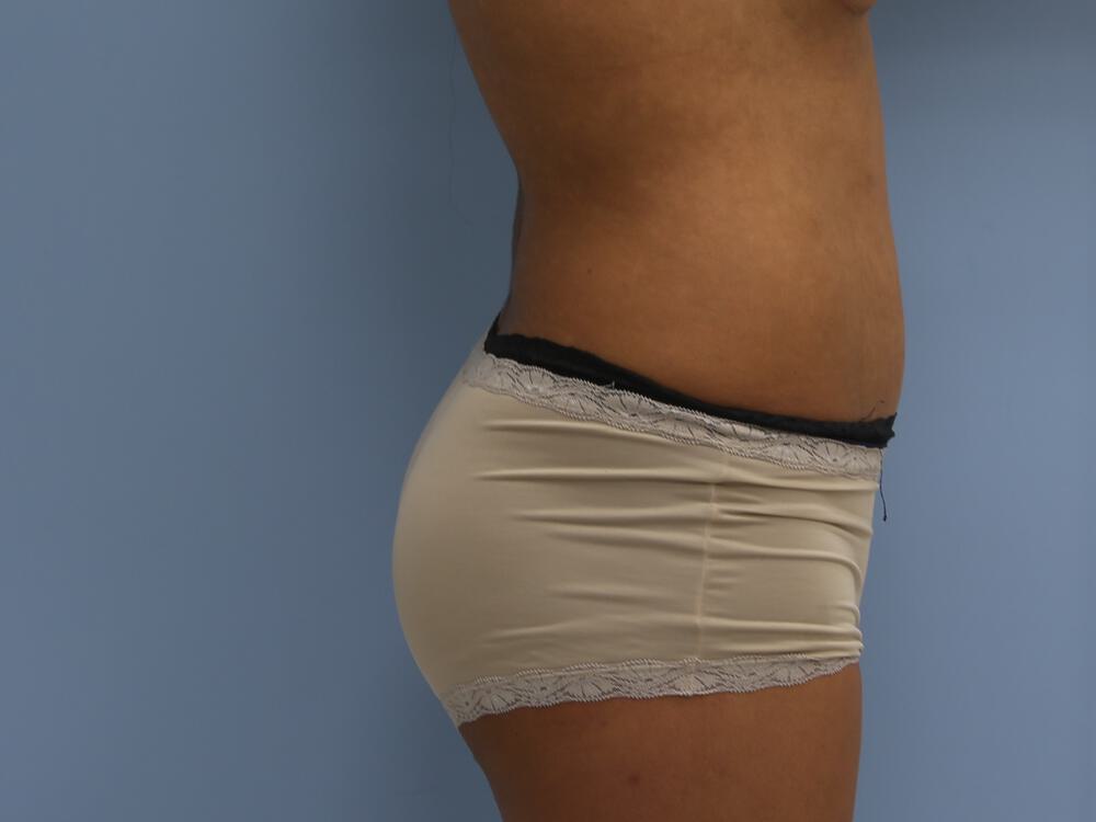 Butt Augmentation Before & After Image
